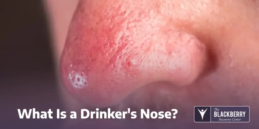 What Is a Drinker's Nose?